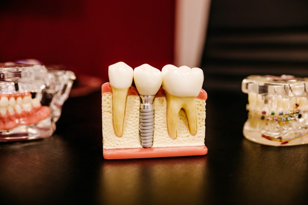 Model implantu zębowego